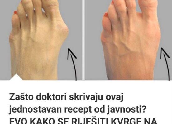 Zašto Doktori Skrivaju Ovaj Jednostavan Recept Od Javnosti? EVO KAKO SE RIJEŠITI KVRGE NA STOPALU POTPUNO PRIRODNO!