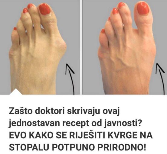 Zašto Doktori Skrivaju Ovaj Jednostavan Recept Od Javnosti? EVO KAKO SE RIJEŠITI KVRGE NA STOPALU POTPUNO PRIRODNO!