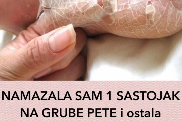 NAMAZALA SAM 1 SASTOJAK NA GRUBE PETE i ostala u šoku: Koža mi je mekana kao bebina, TRIK KOJI ME SPASIO RUŽNIH I ISPUCALIH PETA