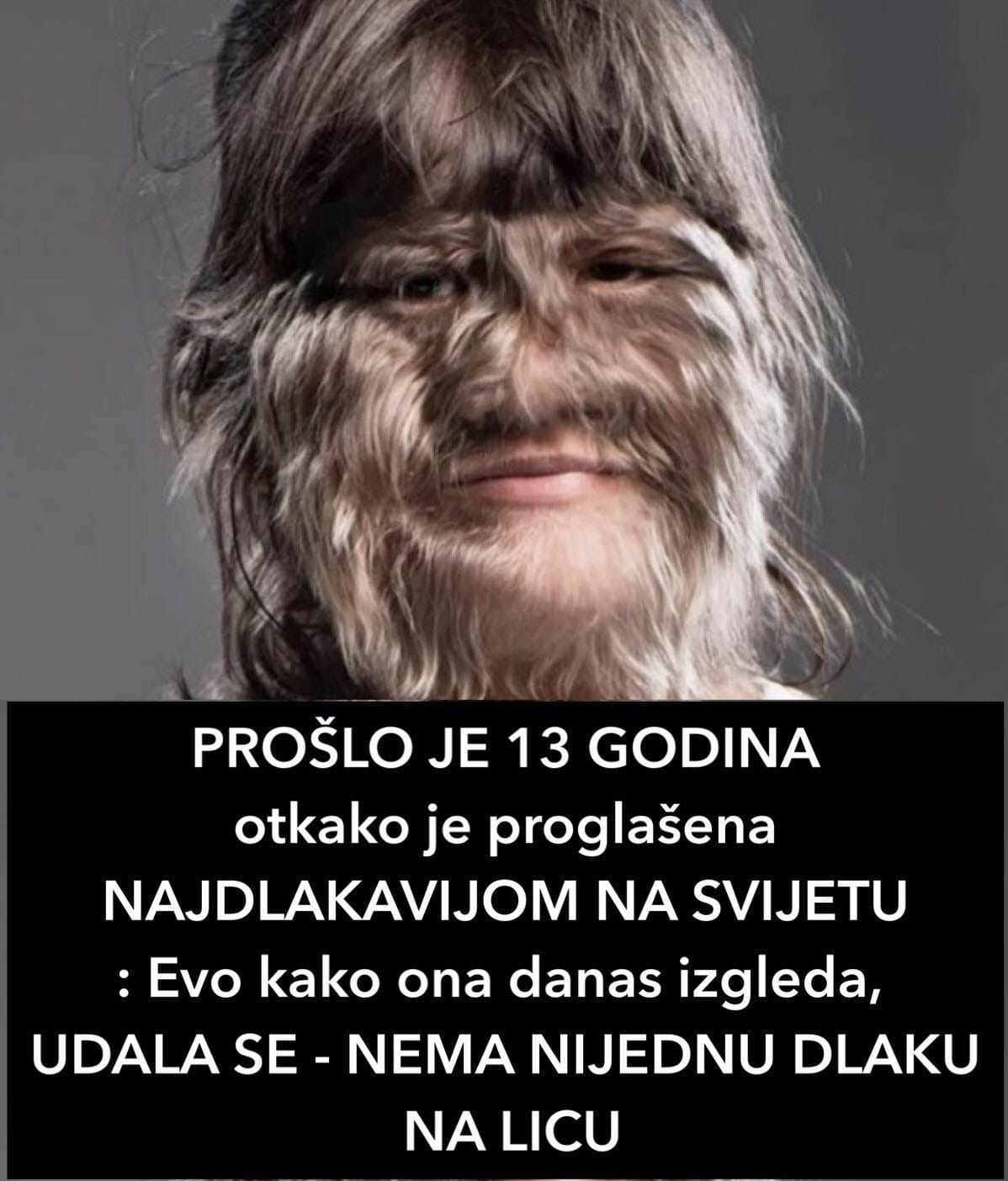 PROŠLO JE 13 GODINA Otkako Je Proglašena NAJDLAKAVIJOM NA SVIJETU: Evo Kako Ona Danas Izgleda, UDALA SE – NEMA NIJEDNU DLAKU NA LICU