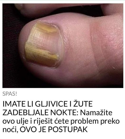 IMATE LI GLJIVICE I ŽUTE ZADEBLJALE NOKTE: Namažite ovo ulje i riješit ćete problem preko noći, OVO JE POSTUPAK