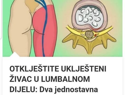 OTKLJEŠTITE UKLJEŠTENI ŽIVAC U LUMBALNOM DIJELU: Dva jednostavna koraka I BOL ZAUVIJEK NESTAJE!