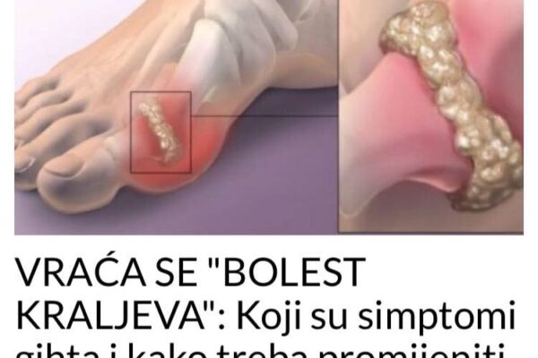 VRAĆA SE “BOLEST KRALJEVA”: Koji su simptomi gihta i kako treba promijeniti ishranu da se izbjegnu bolni napadi