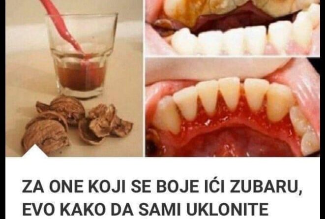 ZA ONE KOJI SE BOJE IĆI ZUBARU, EVO KAKO DA SAMI UKLONITE SAV KAMENAC SA ZUBA: Napravite ovu smjesu, skida ga odmah!