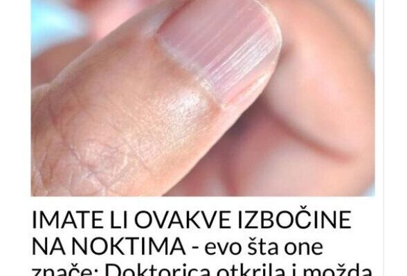 IMATE LI OVAKVE IZBOČINE NA NOKTIMA – Evo Šta One Znače: Doktorica Otkrila I Možda Ćete Se Iznenaditi