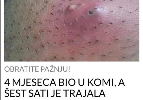 4 MJESECA BIO U KOMI, A ŠEST SATI JE TRAJALA OPERACIJA: Urasla dlaka ga umalo koštala života, a evo kada je smrtonosna